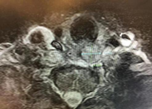 ����������С3.8cm��3.4cm.png