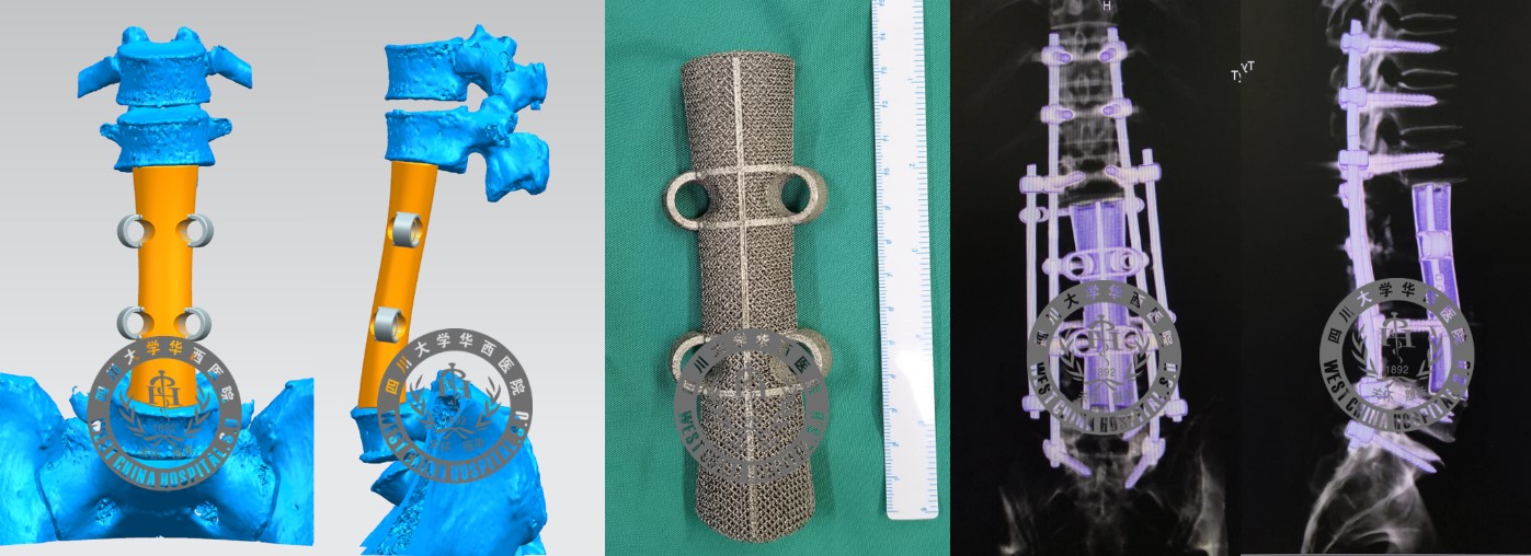 3D打印人工椎体设计、实物及术后复查图.jpg 3D打印人工椎体设计、实物及术后复查图.jpg