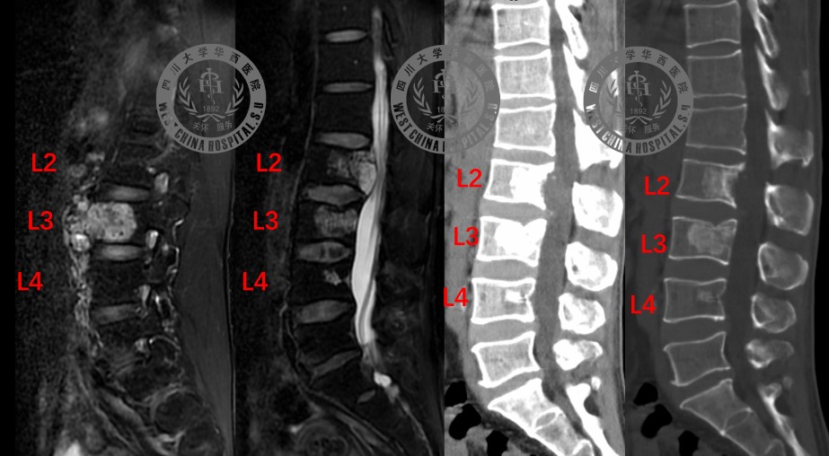 脊索瘤累及腰2、3、4椎共三个椎体.jpg 脊索瘤累及腰2、3、4椎共三个椎体.jpg